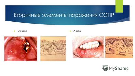 Презентація на тему класифікація захворювань слизової оболонки порожнини рота