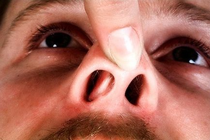 Причини появи закладеності носа без нежитю