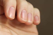 Повздовжні смуги на нігтях - як лікувати білі смужки на нігтях