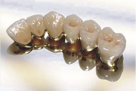Протезування зубів металокерамічними коронками