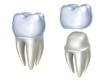 Protetica dinților cu coroane metalo-ceramice