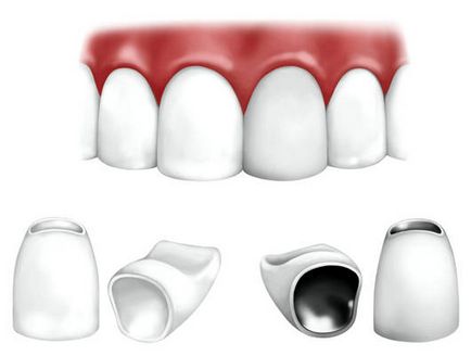 Protetica dinților cu coroane metalo-ceramice