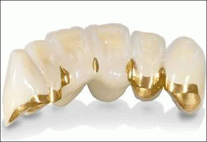 Протезування зубів, рекомендації, види протезування
