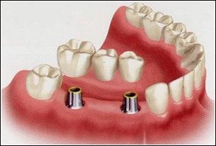 Протезування зубів, рекомендації, види протезування
