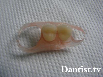 Протез зубної-метелик ціна і фото
