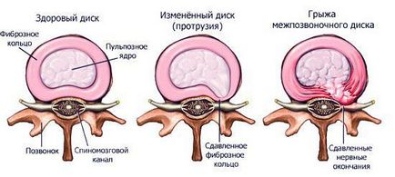 Protruzia coloanei vertebrale provoacă, simptome, tratament