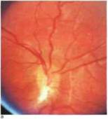 Pseudostasis psevdonevrite) pseudoschnorita (pseudostage) a nervului optic