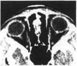 Pseudostasis psevdonevrite) pseudoschnorita (pseudostage) a nervului optic