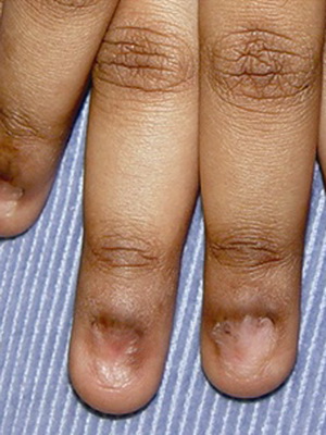 Птерігіум нігтя - причини і лікування