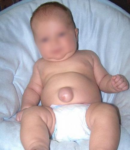 Hernia ombilicală la nou-născuți sau lărgirea inelului ombilical