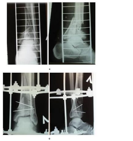 Tratamentul chirurgical al fracturilor gleznei