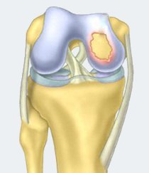 Reconstrucția cartilajului articular (din celule stem), clinica nordorthopedică din Lituania