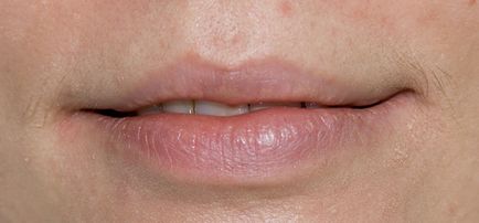 Ретенційна кіста нижньої губи - основні причини і варіанти успішного лікування