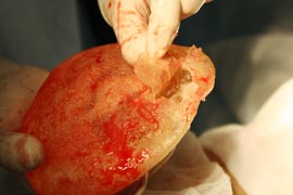 Ревізія імплантату молочної залози