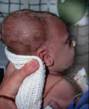 Született sérülései a gyermek fejét szubkután vérömleny, cephalohematoma, generikus tumor újszülöttek (születés) Született sérülései a gyermek fejét szubkután vérömleny, cephalohematoma, születés újszülött tumor