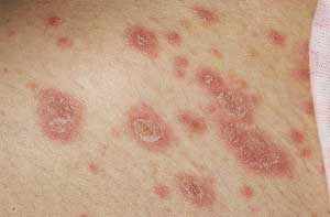 Simptomele lichenului roz și tratamentul la domiciliu