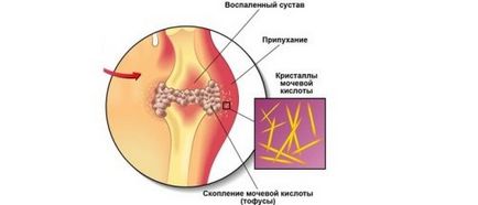 Селера при подагрі користь і шкода, рецепти