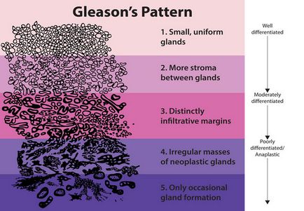 Шкала Глісон (gleason) при раку передміхурової залози - сума балів і оцінка стадії