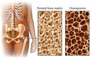 Simptomele și tratamentul osteopeniei la copii și adulți