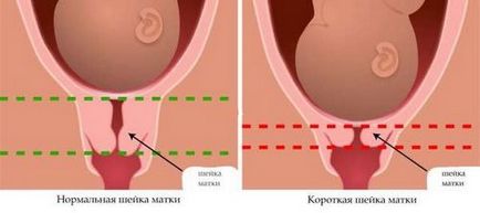 Simptomele de scurtare a colului uterin în timpul sarcinii