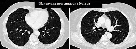 Simptomele sindromului Cotard, tratamentul, cauzele bolii și prevenirea