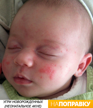 Kiütés a csecsemők és kisbabák fotó okoz kiütések - napopravku
