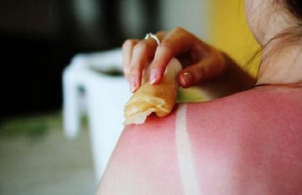 Sfaturi pentru tratarea pielii după arsurile solare 1
