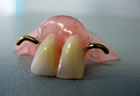 Metode de protetică a dinților fără rotire, microprotetice