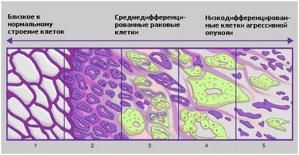 A mértéke prosztatarák (rákos sejtek differenciálódása) A mértéke prosztatarák