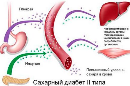 Типи і види цукрового діабету, діабет інфо