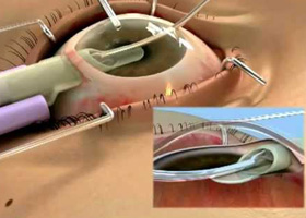 Transplantul cornean - oftalmologie centru oftalmologic