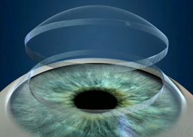 Transplantul cornean - oftalmologie centru oftalmologic