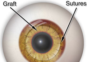 Transplantul cornean - oftalmologie centru oftalmologic