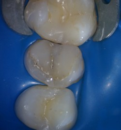 Видалення сторонніх тіл з кореневих 1 - стоматологічна клініка - стоматологія мс, Єкатеринбург
