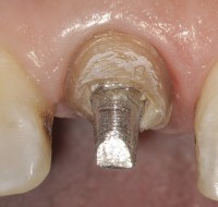 Eltávolítják az idegen testeket a gyökér 1 - fogászati ​​klinika - fogászat ms ekaterinburg