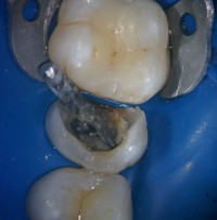 Видалення сторонніх тіл з кореневих 1 - стоматологічна клініка - стоматологія мс, Єкатеринбург