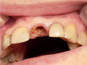 Видалення коренів зубів