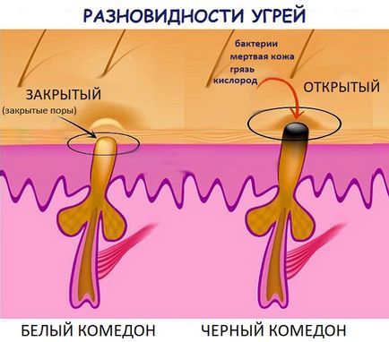 Угри на губах