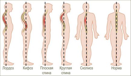Exerciții și postură - curbură a coloanei vertebrale, lordoză, kyfoză, scolioză