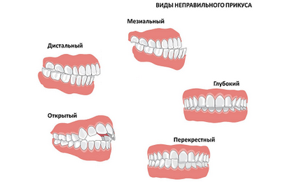 види прикусів