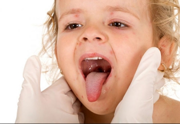 Вірус Коксакі у дітей і дорослих, причини і лікування захворювання