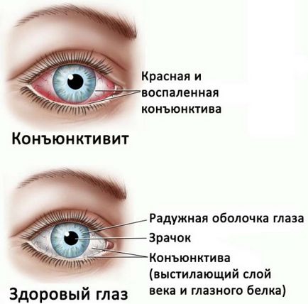 Вірусний кон'юнктивіт у дитини до року