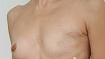 Питання і відповіді по килевидной деформації - хірургія лійкоподібної деформації грудної клітини
