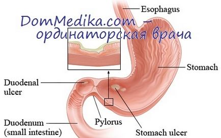 Запальні захворювання кишечника (ВЗК)