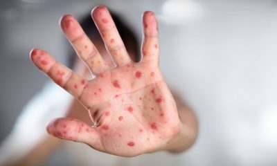 În Rusia au fost create vaccinuri pentru alergii la mesteacăn, pelin și timothy - riami 1