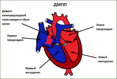 Вроджена вада серця причини - лікування серця