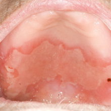 Pemphigus vulgaris fotó kezelés () Pemphigus vulgáris kép, kezelés