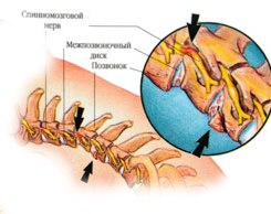 Hulti - sursa leziunilor coloanei vertebrale cervicale