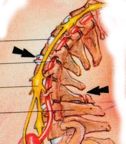 Hulti - sursa leziunilor coloanei vertebrale cervicale