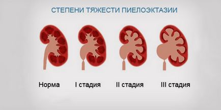 Хронична бъбречна недостатъчност (CRF) етап, скоростта на налягане, задържане на вода